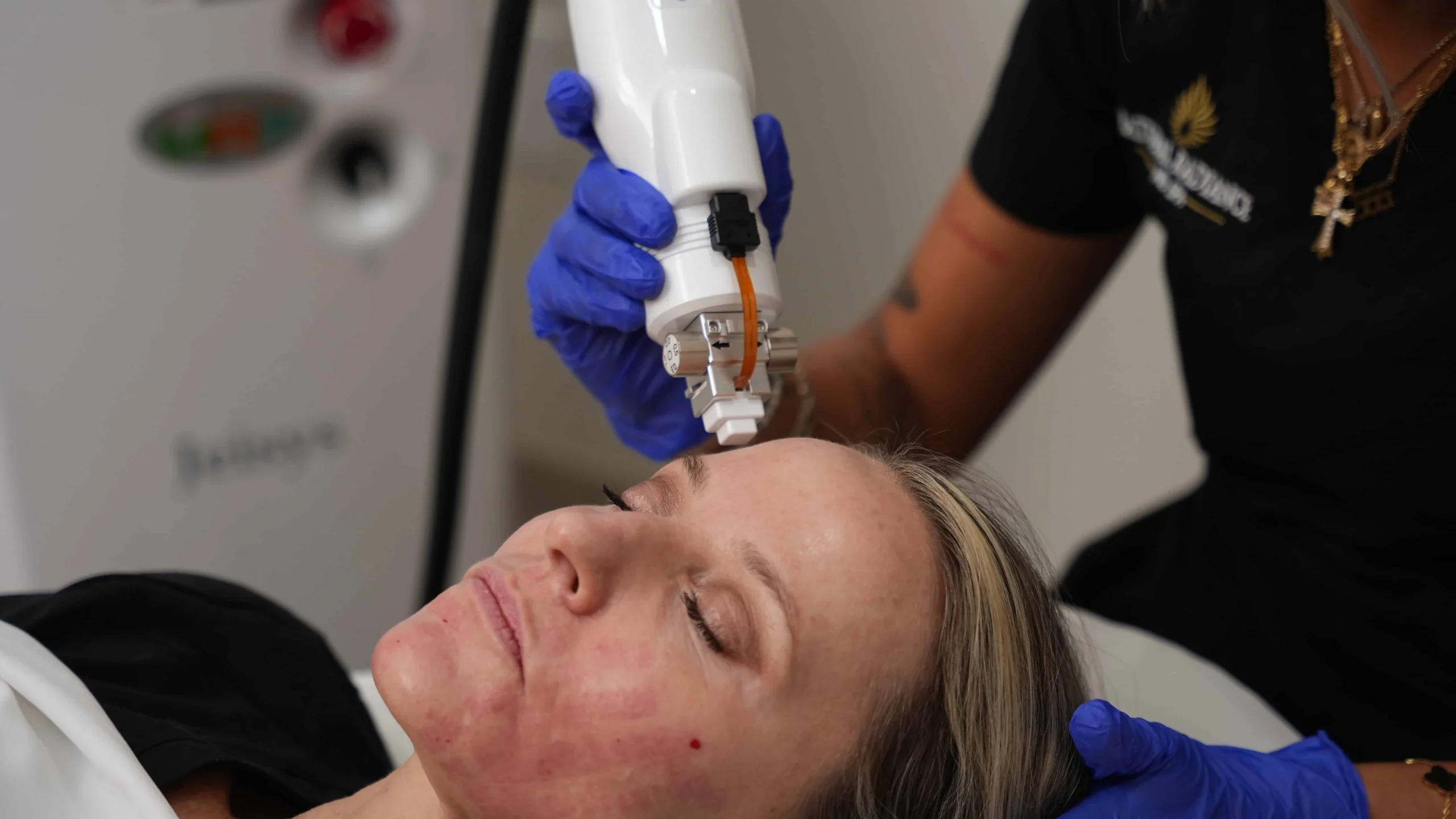 RF Microneedling: Superior Safety and Amplified Results