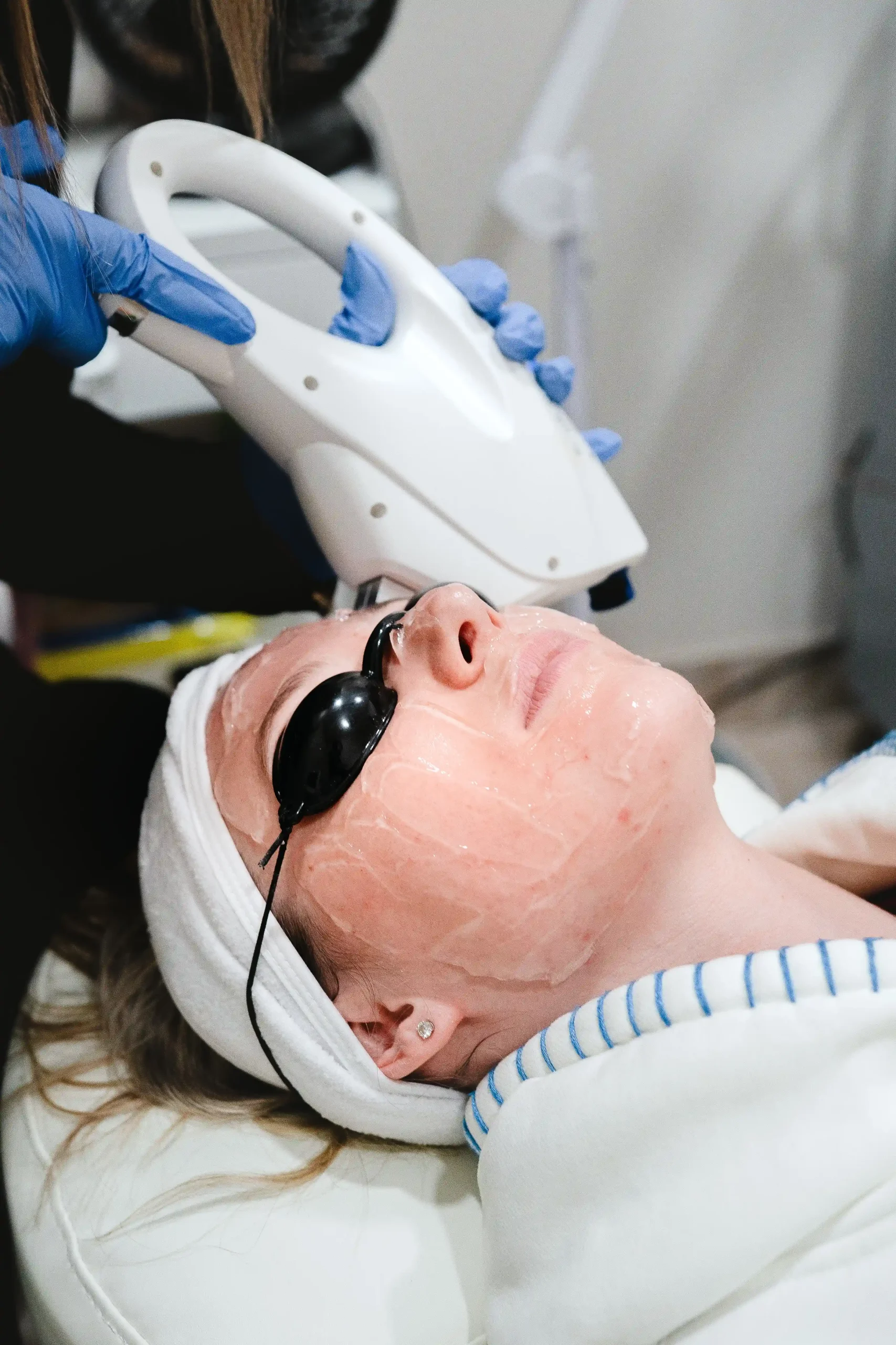 IPL Photofacial