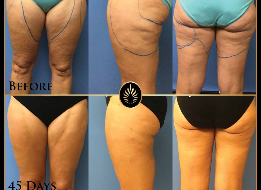 lipo no fat transfer