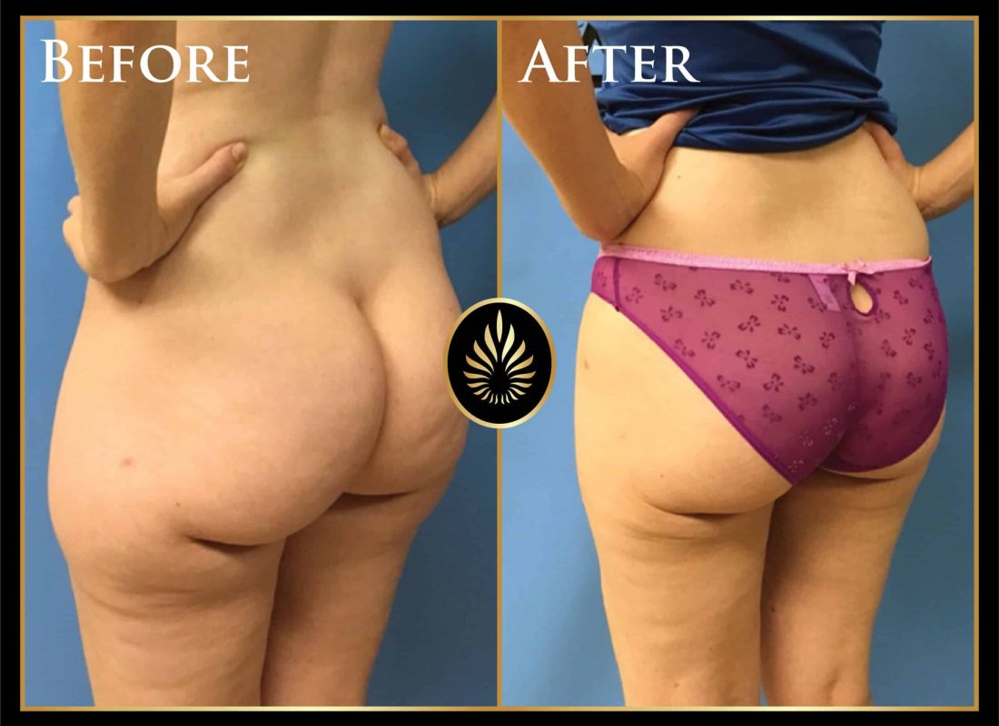 lipo no fat transfer