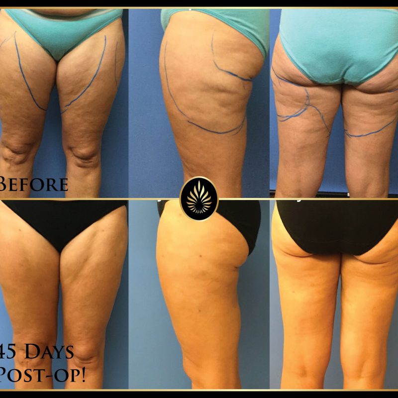 lipo no fat transfer b&a-01