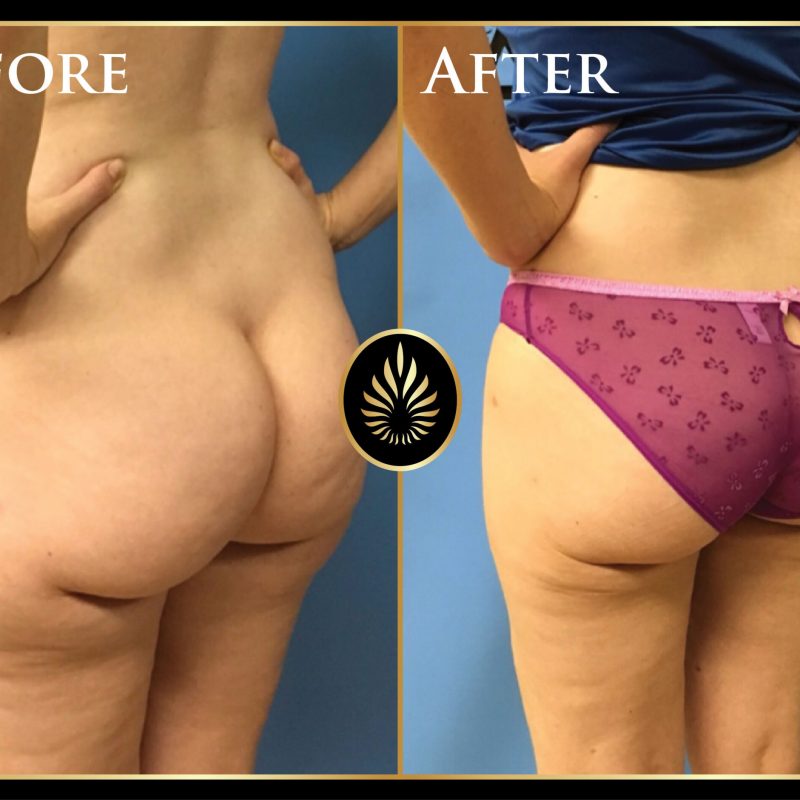 lipo no fat transfer b&a-02